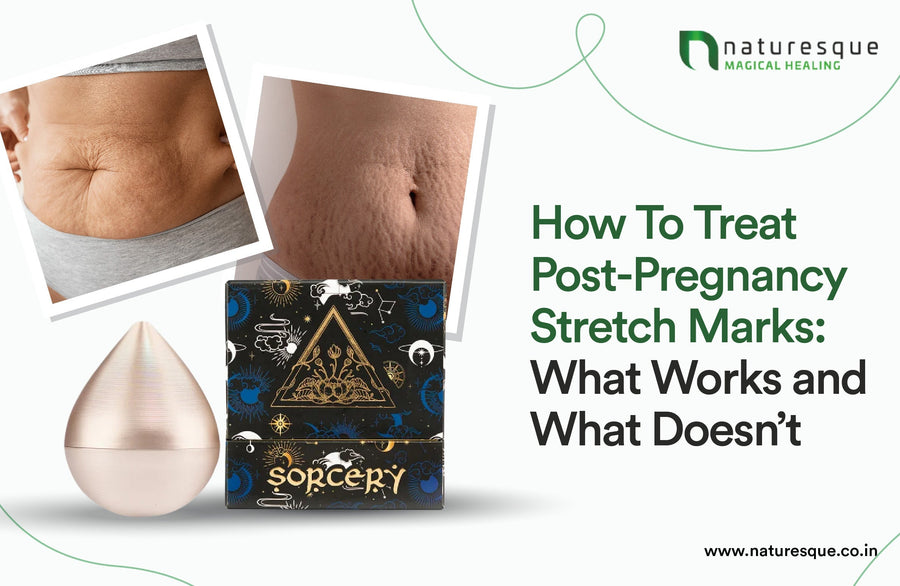 How To Treat Post-Pregnancy Stretch Marks: What Works and What Doesn’t